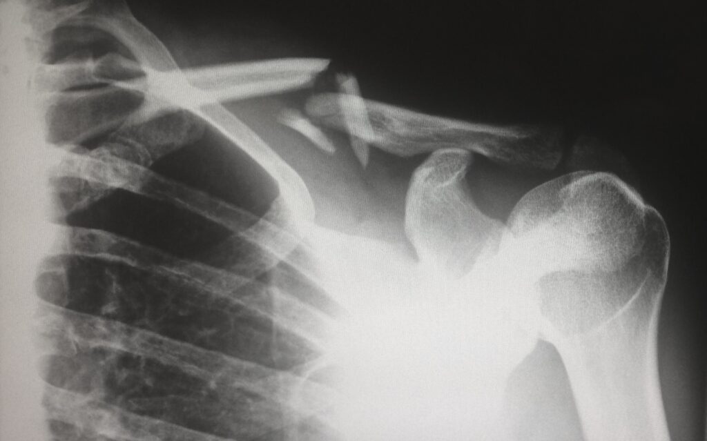 Clear injury showing broken clavicle